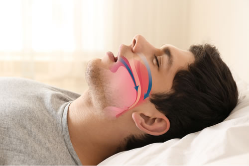 Sleep apnea treatment