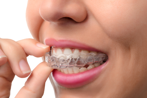 Invisalign treatment