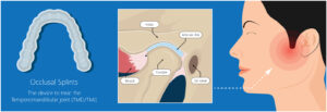 Advantages of using splint therapy for TMJ pain