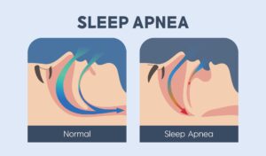 What Is sleep Apnea